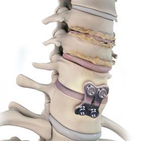 adjacent-segment-disc-disease