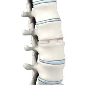 anterior-lumbar-interbody-fusion