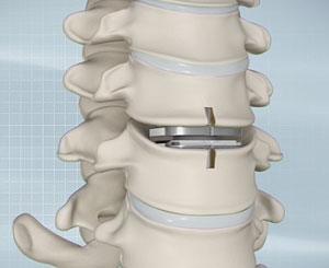 artificial-cervical-disc-replacement