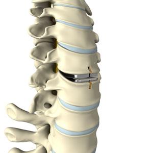 anterior-cervical-corpectomy