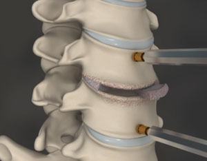 cervical-discectomy