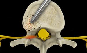 anterior-cervical-corpectomy