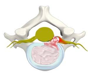 cervical-herniated