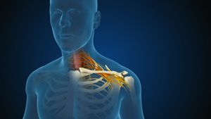 Cervical Myelopathy