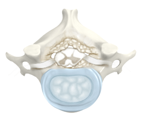 cervical-stenosis