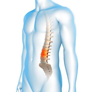 degenerative-spinal-conditions