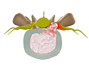 Spinal Disc Herniation