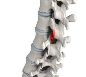 Facet Joint Arthritis