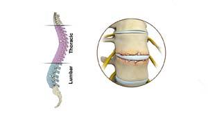 Fracture of the Thoracic and Lumbar Spine