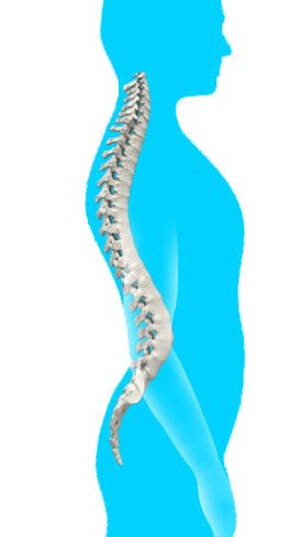 lordosis