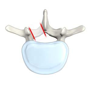 lumbar-foraminotomy-surgery