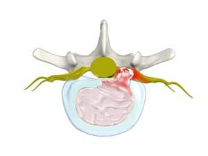 lumbar-herniated-disc