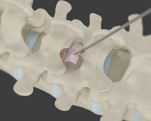 minimally-invasive-lumbar-discectomy