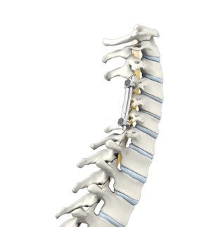 posterior-cervical-fusion