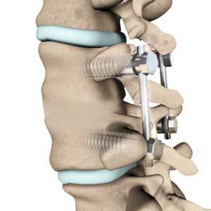 cervical-herniated