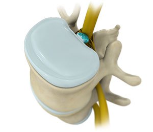 spinal-decompression