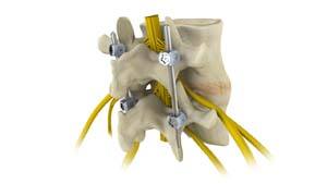 Spinal Fusion