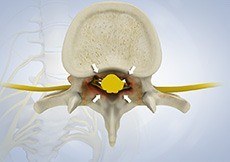 spinal-stenosis-cervical