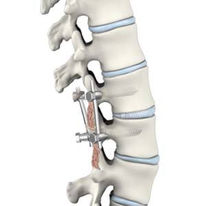 Spondylolisthesis