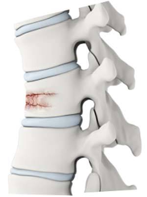 vertebral-fracture